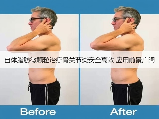 自体脂肪微颗粒治疗骨关节炎安全高效 应用前景广阔(图3) 自体脂肪微颗粒治疗骨关节炎安全高效 应用前景广阔(图3)